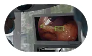 Endoscopic view on monitor showing a body cavity with a yellow measurement marker.